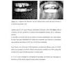 Traitements De L'apnée Du Sommeil : Avantages Et Inconvénients Du Traitement Des Appareils Dentaires Bucco-dentaires